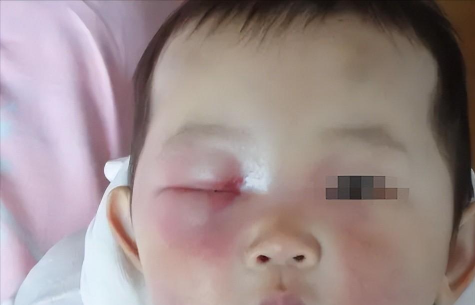7岁男孩眼球被炸后融化,七岁男童眼睛秒被溶化