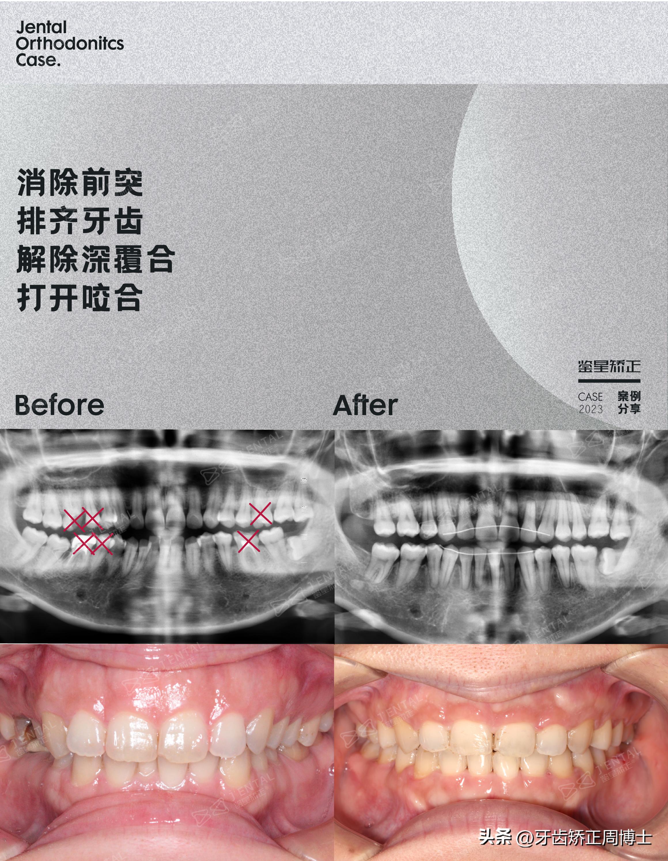骨性龅牙怎么通过普通的矫正改善,骨钉如何解决骨性龅牙