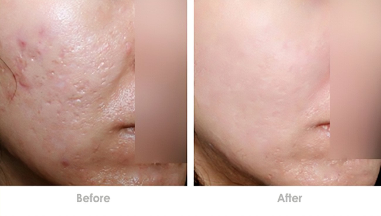 孩子起痘自卑不自信该怎么引导,孩子长青春痘不自信怎么引导