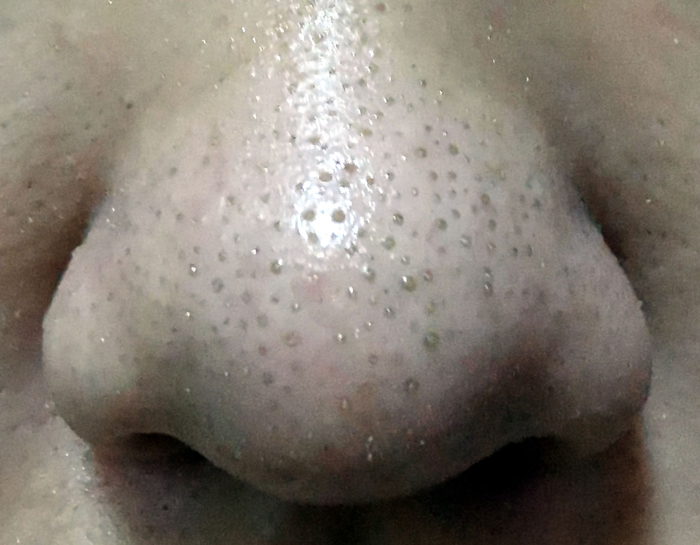 眉心鼻翼和下巴长粉刺为什么,鼻头上起粉刺什么原因引起的图片