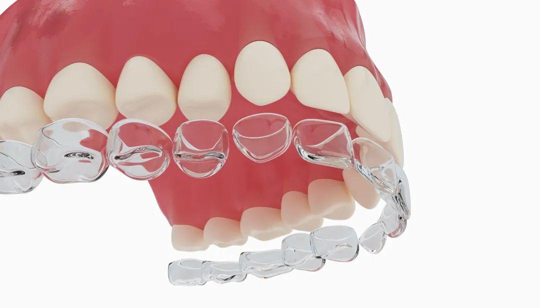 一颗牙长歪矫正要花多少钱,14岁牙歪了怎么自己矫正