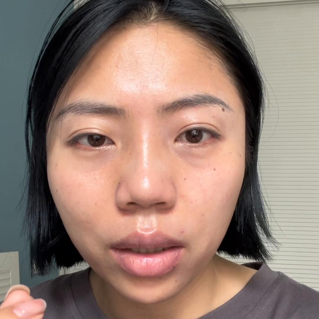 感觉目前很焦虑,做完鼻子19天为何山根看起来很宽