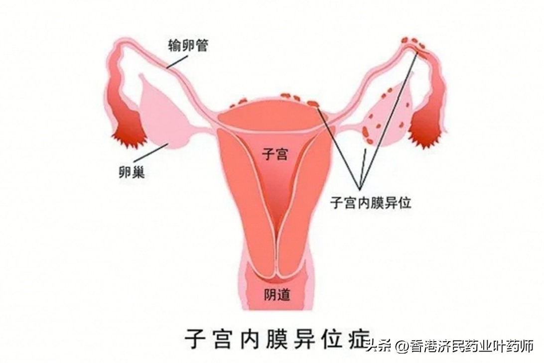 减少经期疼痛,减少姨妈疼痛