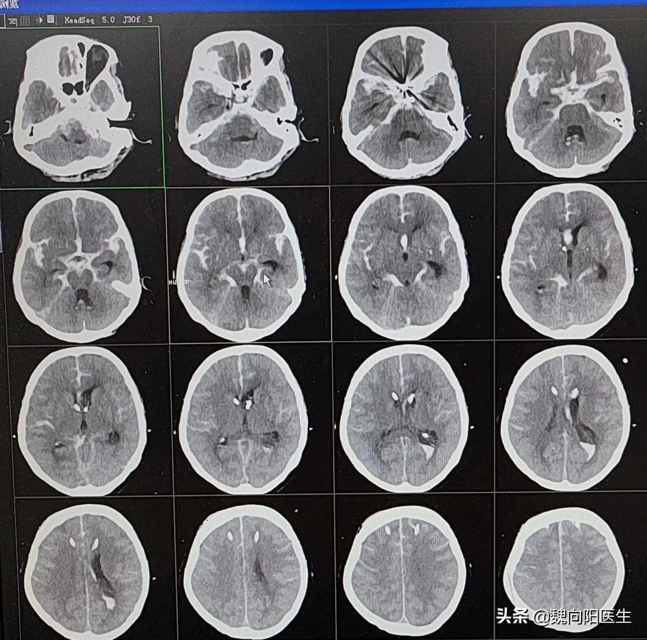 蛛网膜下腔出血简单确诊,蛛网膜下腔出血最有效的检查方法