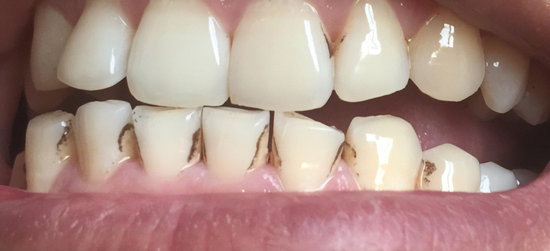 种植牙怎么注意口腔卫生,种植牙如何保养才能用的时间最长