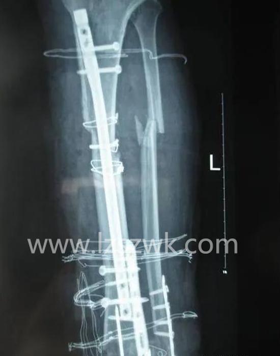 如果有一段骨头缺损，该怎样治疗？