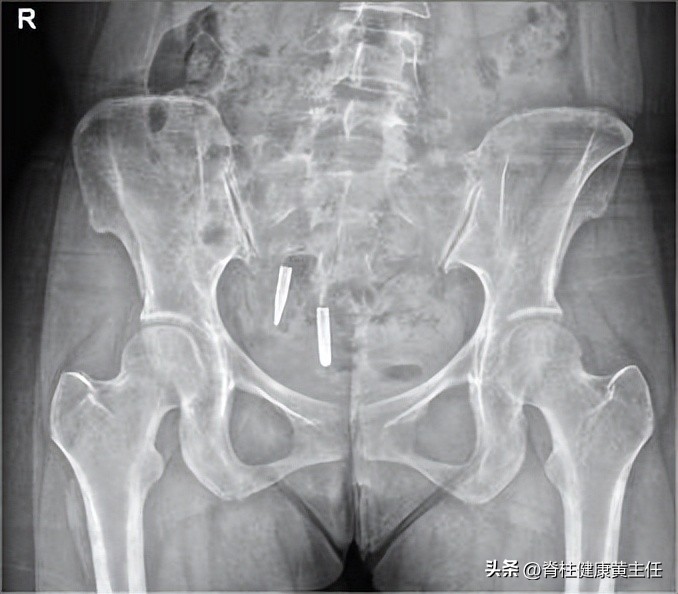 急性腰扭伤的原因症状及处理方法,急性腰扭伤原因症状及处理方法