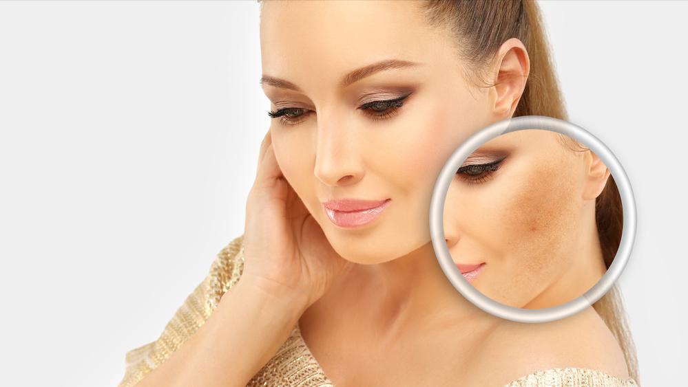 红霉素软膏可以治疗手上老年斑,红霉素软膏可以去除老年斑么