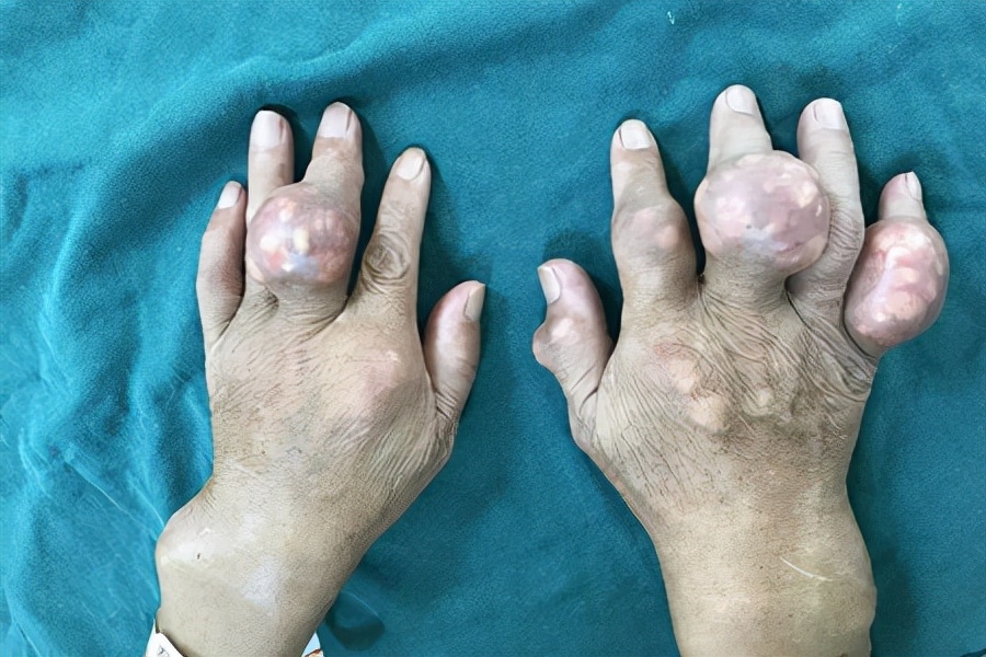 怎样才能确定是痛风性关节炎,关节疼如何区分是痛风还是风湿