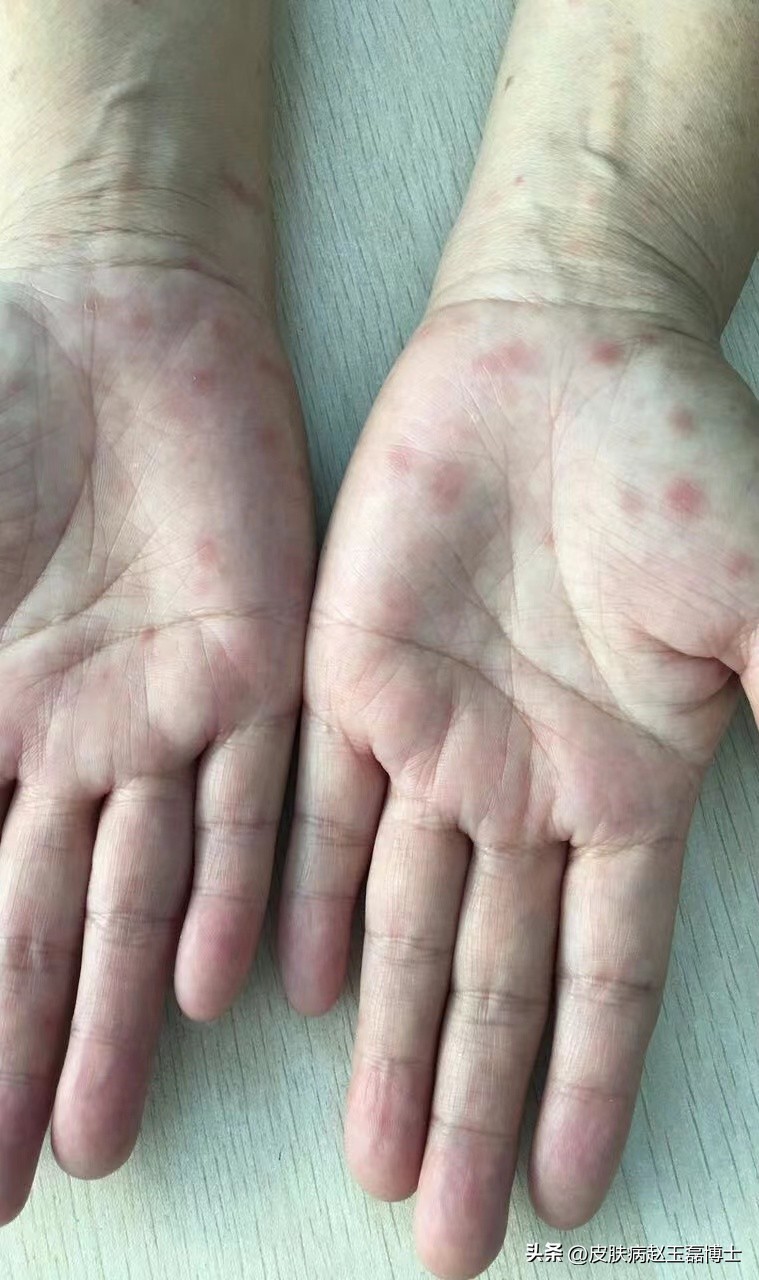 皮肤过敏竟被误诊为梅毒,身上出现梅毒疹