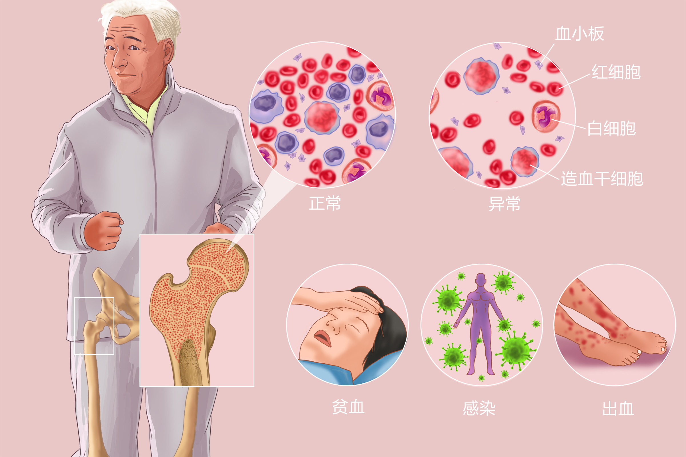 mds白血病如何让骨髓恢复正常,治疗mds转急性髓系白血病多少钱