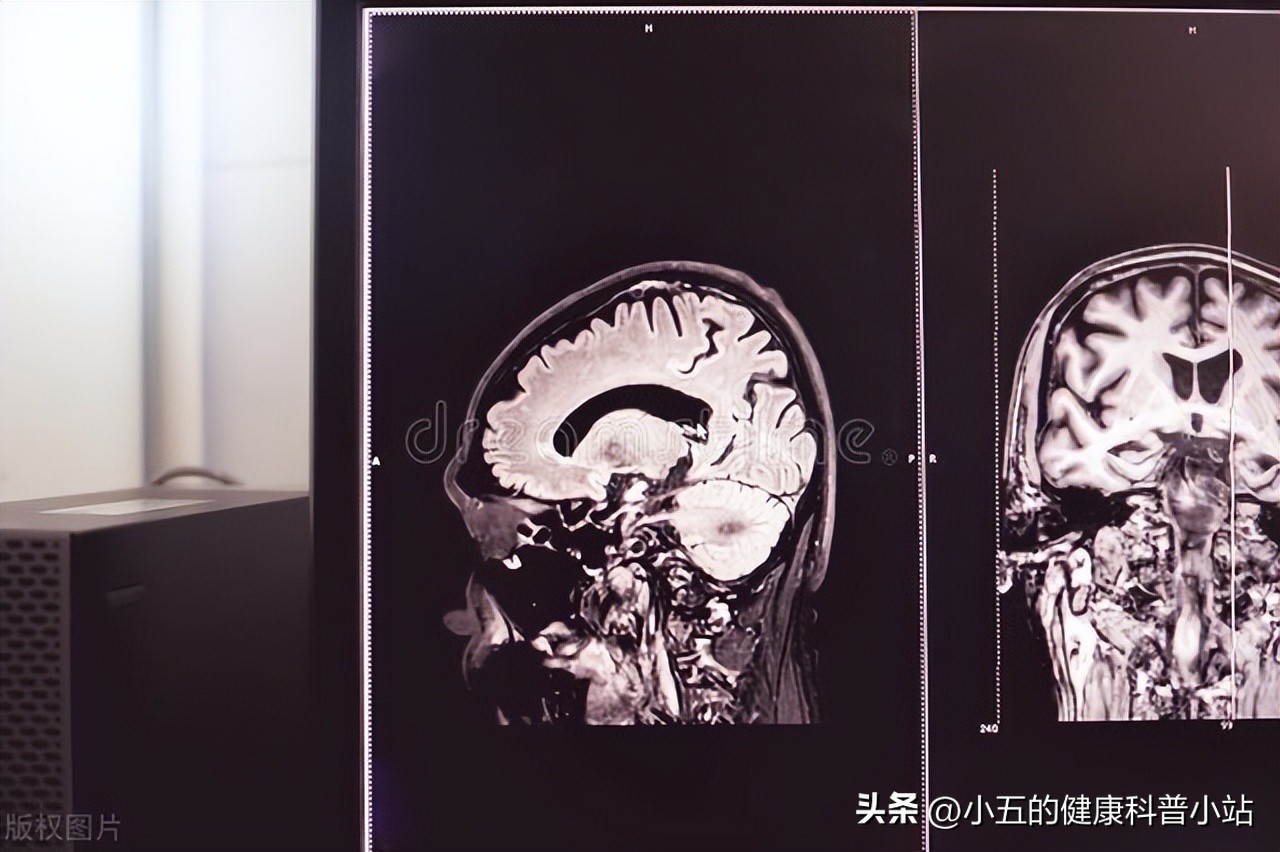 改善脑供血预防老年痴呆的方法,脑供血不足怎样防治才不会成痴呆