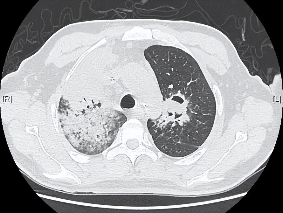 病死率和致死率,病死率20%