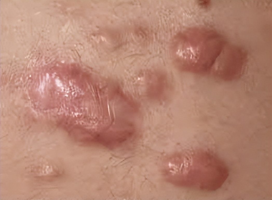 让人苦恼的瘢痕疙瘩，有啥办法处理它？