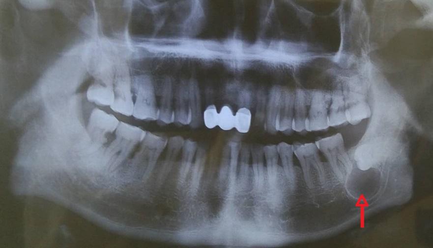 牙齿有囊肿症状有哪些,牙齿囊肿疼怎么缓解