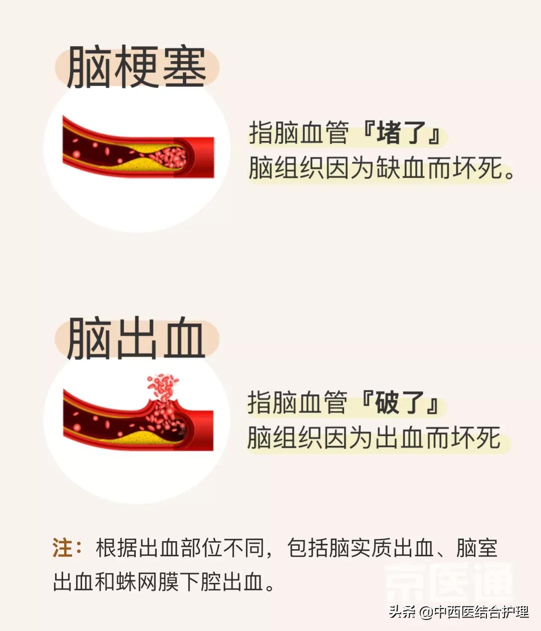 「脑梗病科普」一个周末8个脑梗，他们都有一共同特点！​神药安宫牛黄丸到底能不能救命？