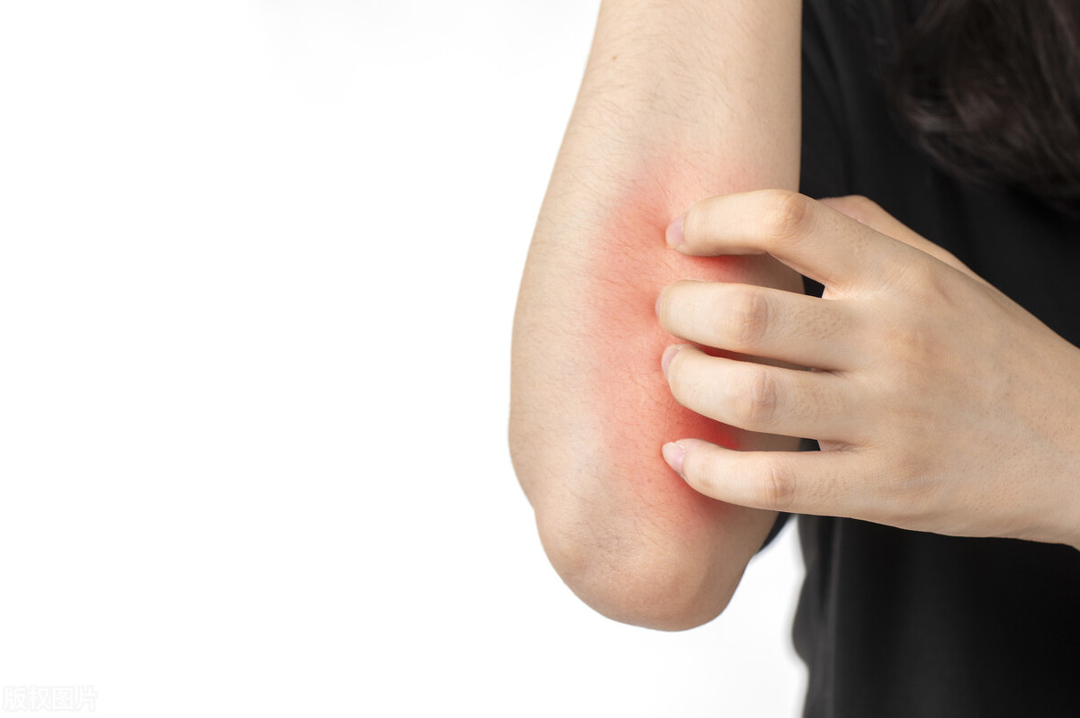 得了急性荨麻疹很害怕,常见的皮肤病荨麻疹治疗