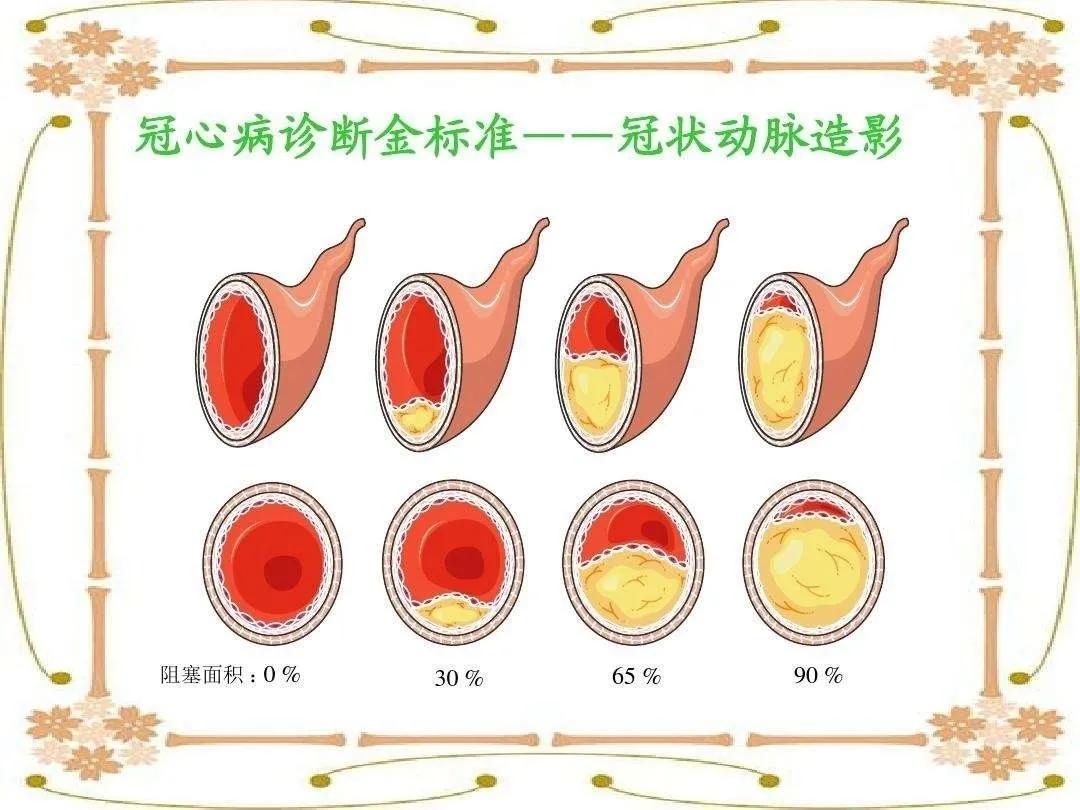 得了冠心病怎样预防冠心病,冠心病算大病吗怎样预防冠心病