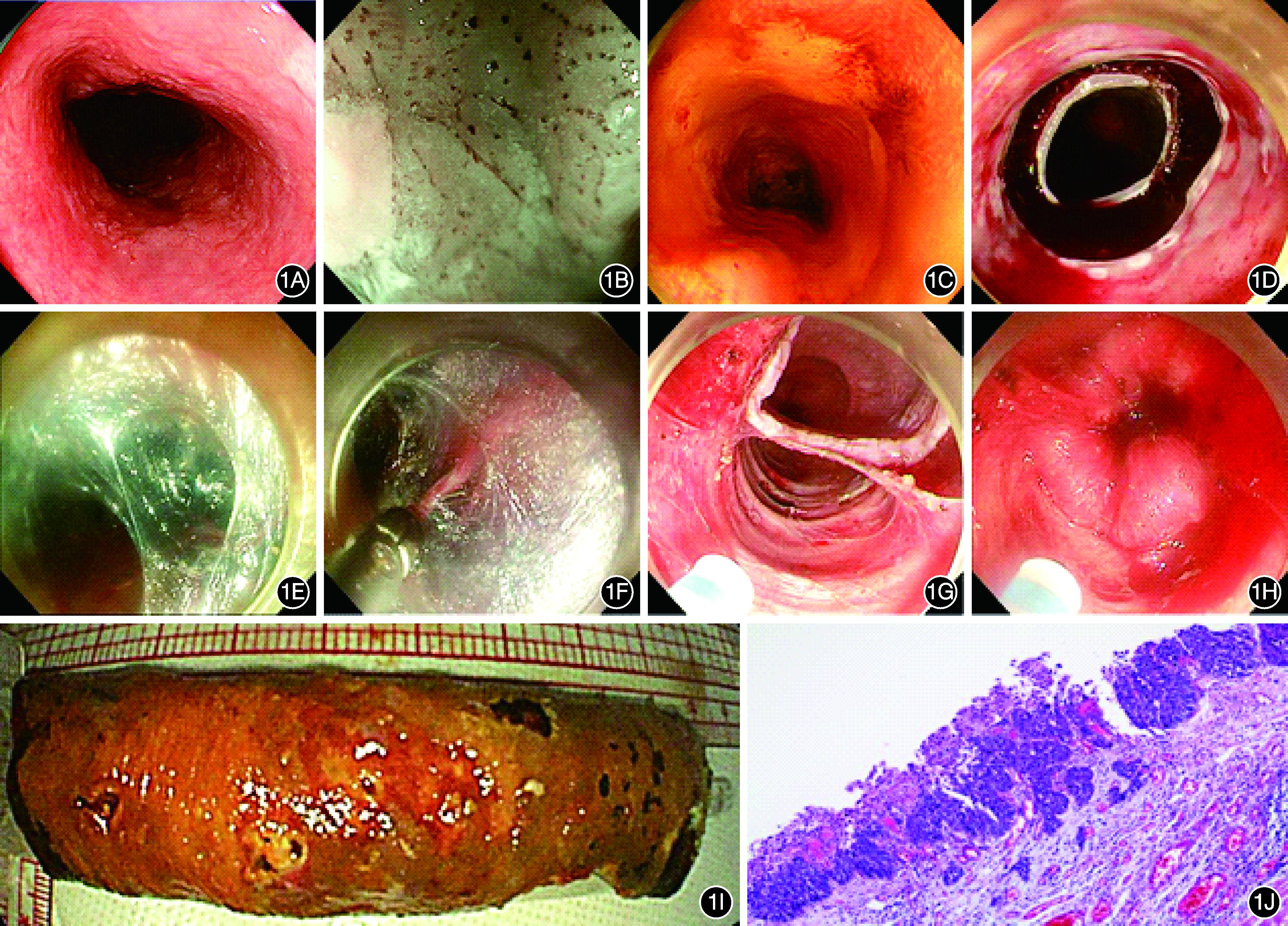 改良多隧道法内镜黏膜下剥离术治疗长度大于8cm食管全周浅表癌的临床研究