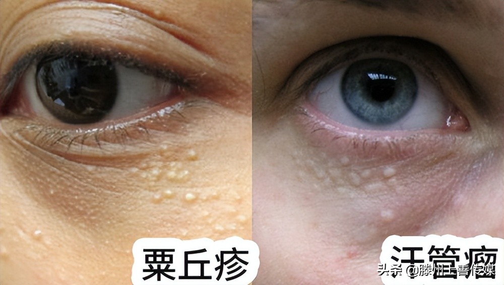 长了脂肪粒觉得眼前模糊正常吗,为什么脂肪粒会越长越多