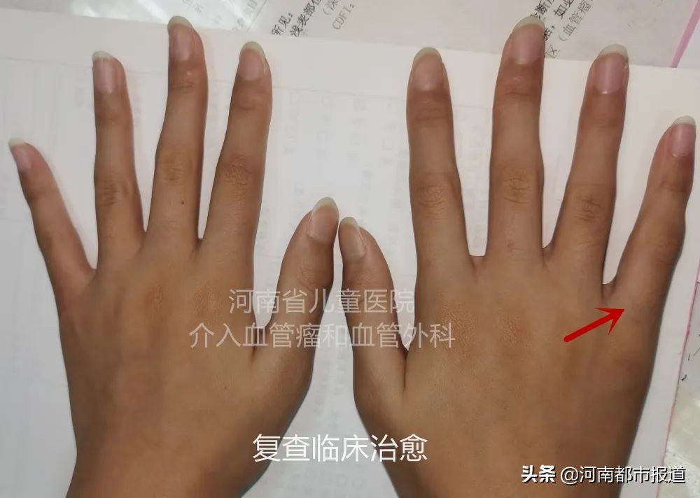 会跳动的手指,大拇指弯曲会自动抖动是什么病