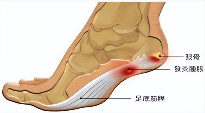 脚后跟痛警惕三种病,脚后跟痛要警惕什么