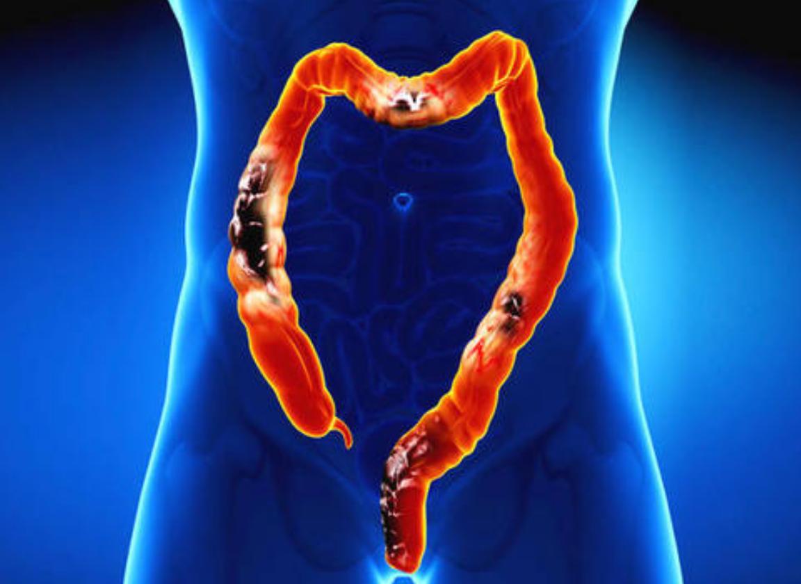 42岁女子长期便秘,23岁女子便秘17天