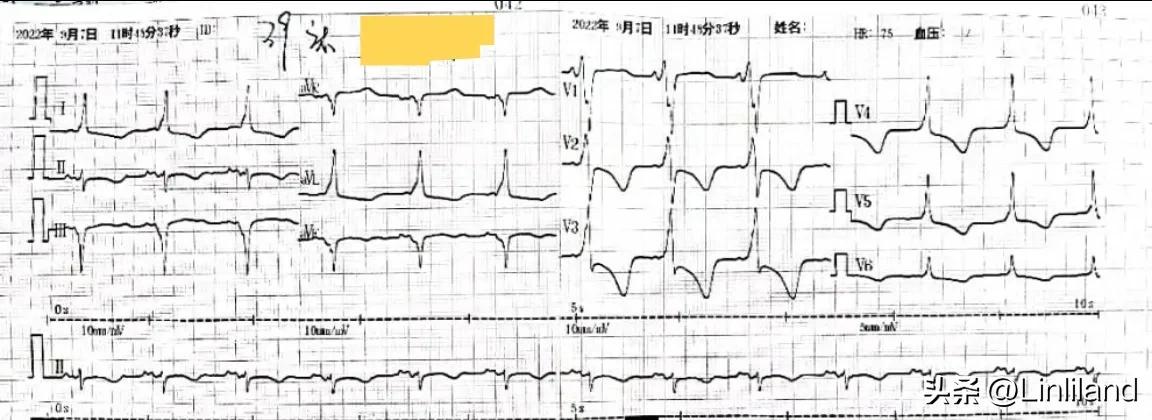 过速性房颤治疗,持续性房颤心动过速