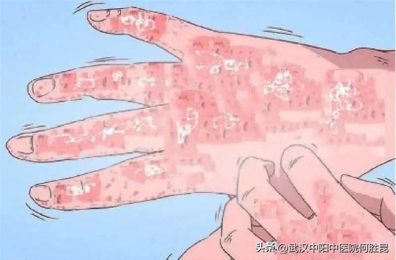 手关节银屑病治疗期间脱皮,银屑病关节肿疼手掌黄