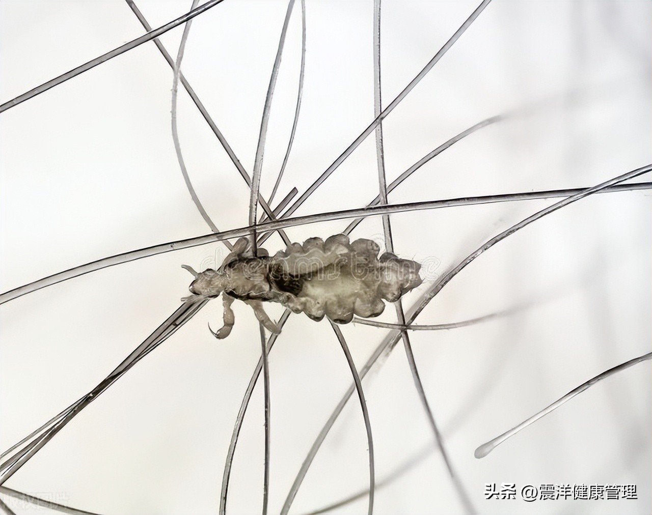 阴虱是从哪里来的什么原因造成的,阴虱是怎样产生的怎样治疗阴虱