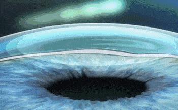 哪种近视手术对散光矫正更好,大散光为什么适合做近视矫正手术