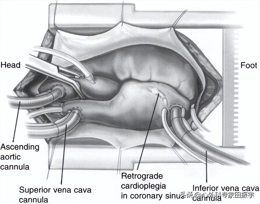 二尖瓣成形术,二尖瓣成形术后需要静养多久
