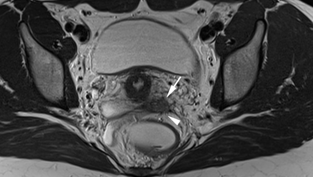 MRI如何评估子宫内膜异位症？这10个病例会帮助您
