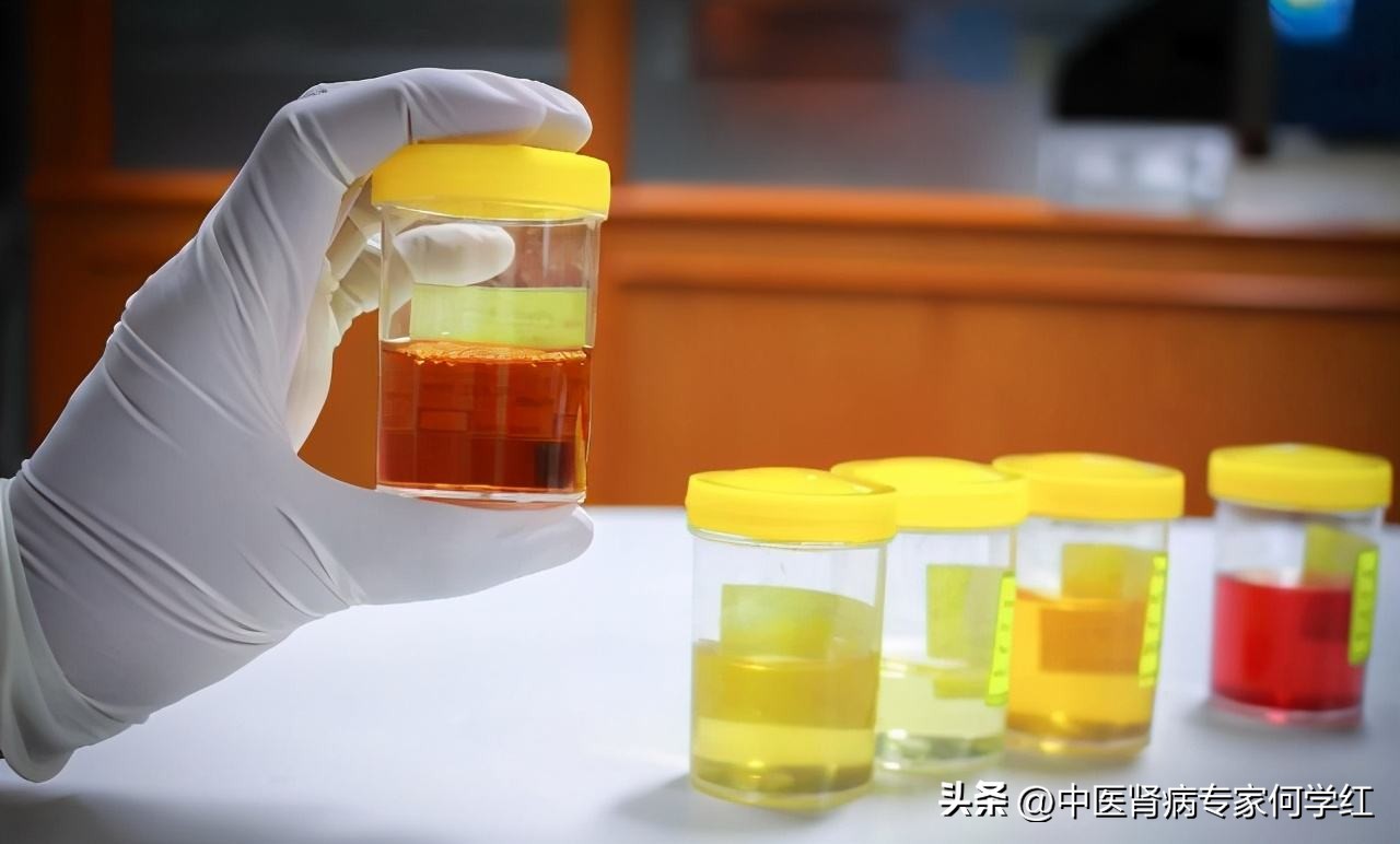 76岁重度肾功能损害能活多久,肌酐131肾功能损坏什么程度