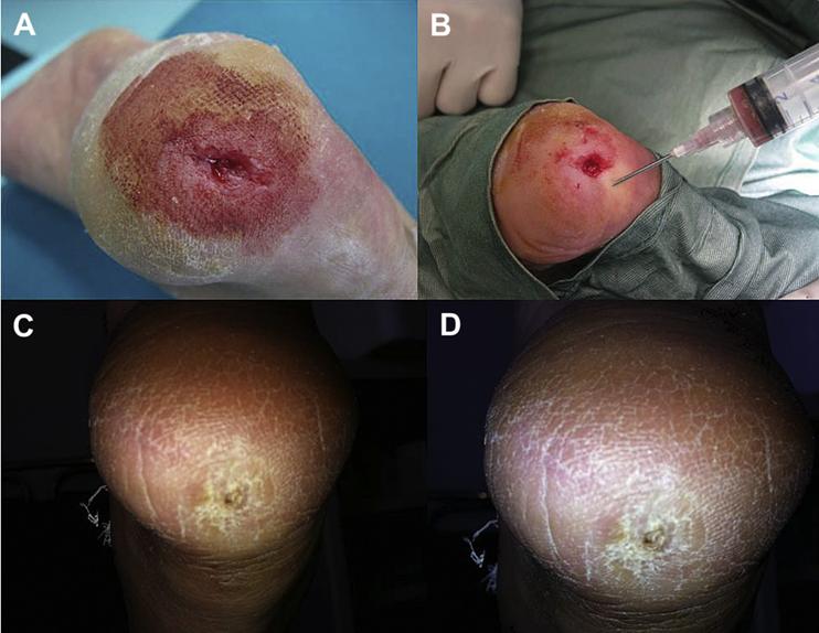 全球干细胞最新临床进展,干细胞治疗的发展历程知多少