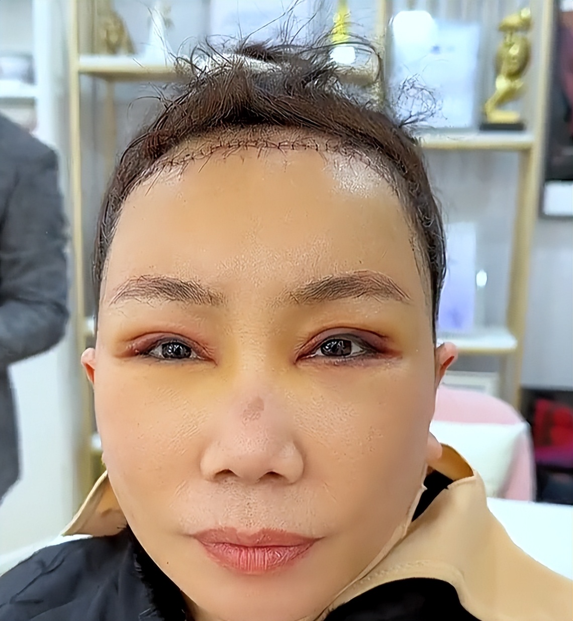 大拉皮手术34岁适合做吗,56岁面部拉皮术后效果