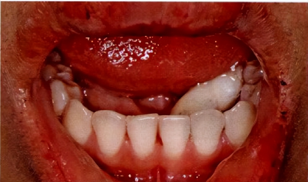 摔掉牙齿怎么补救,摔了一跤牙怎么快速牢固