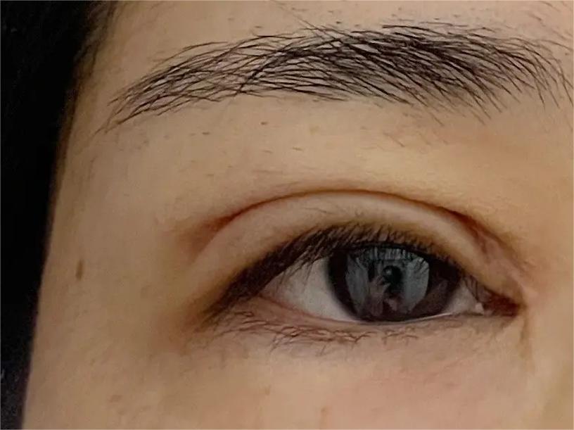 双眼皮术后眼头紧绷有细纹,双眼皮术后很多疤痕怎么办