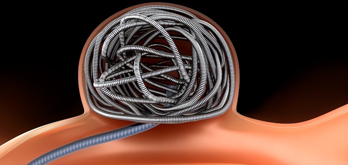 介入治疗能否疏通血管,心脑血管介入治疗最好医院