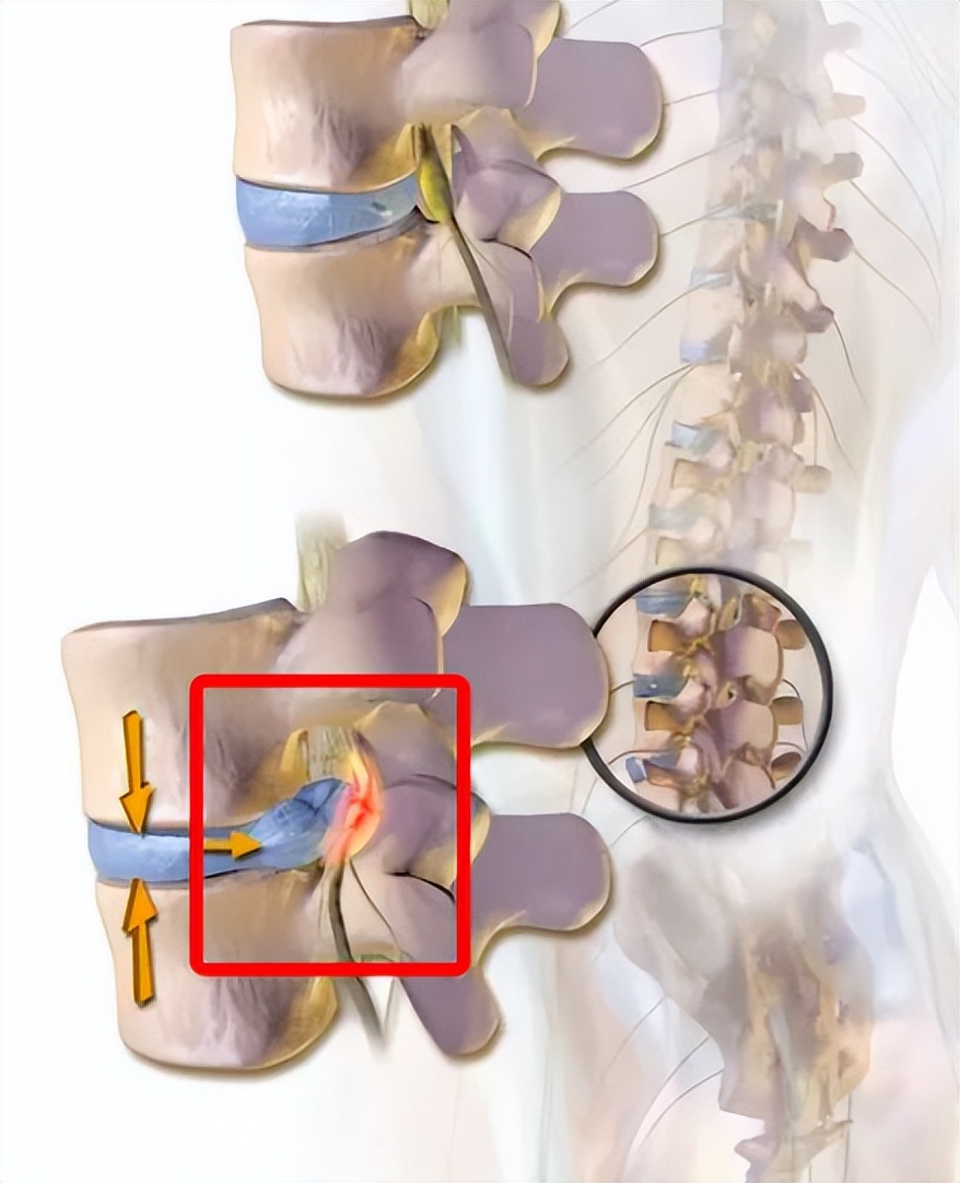 腰椎间盘4-5节突出最好治疗方法,预防腰椎间盘问题