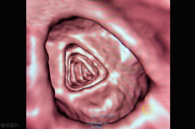 癌症免疫疗法为何对大多数人无效,癌症全身扩散有必要用免疫疗法吗