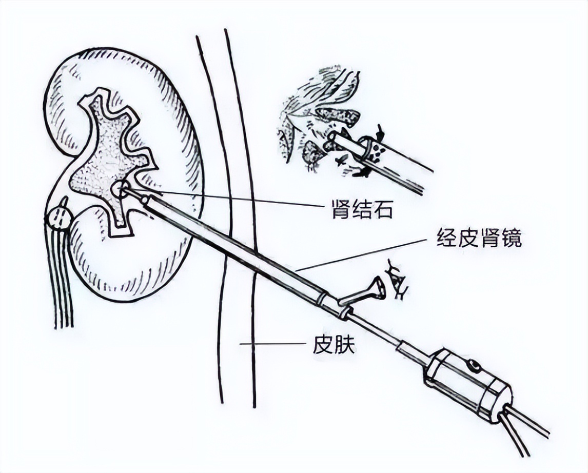 20年拖延不治双肾布满结石长成“珊瑚”！肾脏的通道被满满塞住