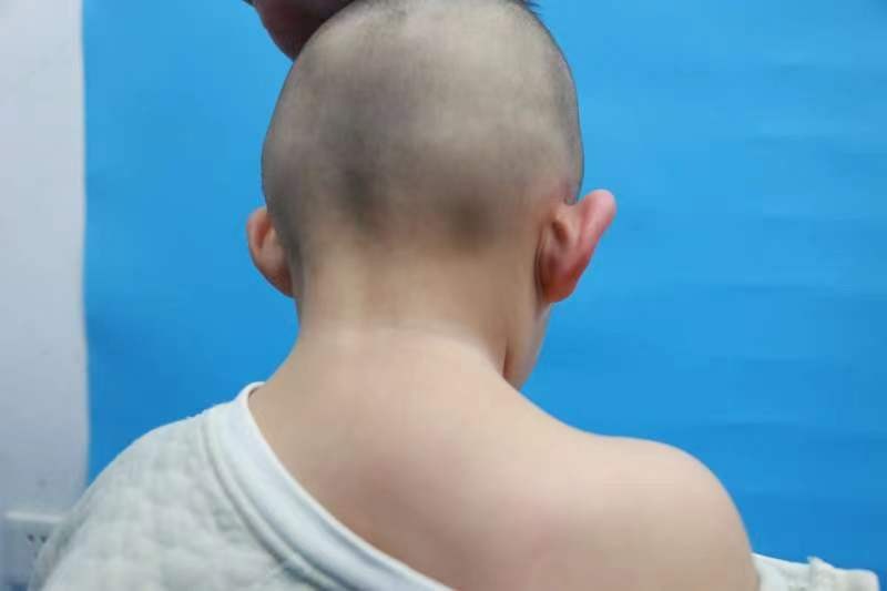 2岁男孩右侧耳后部淋巴管瘤介入治疗