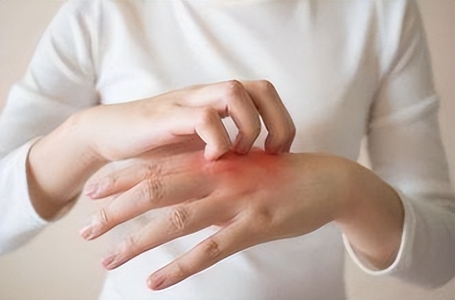 湿疹是什么引起的得了湿疹怎么办,得了湿疹怎样用中药调理