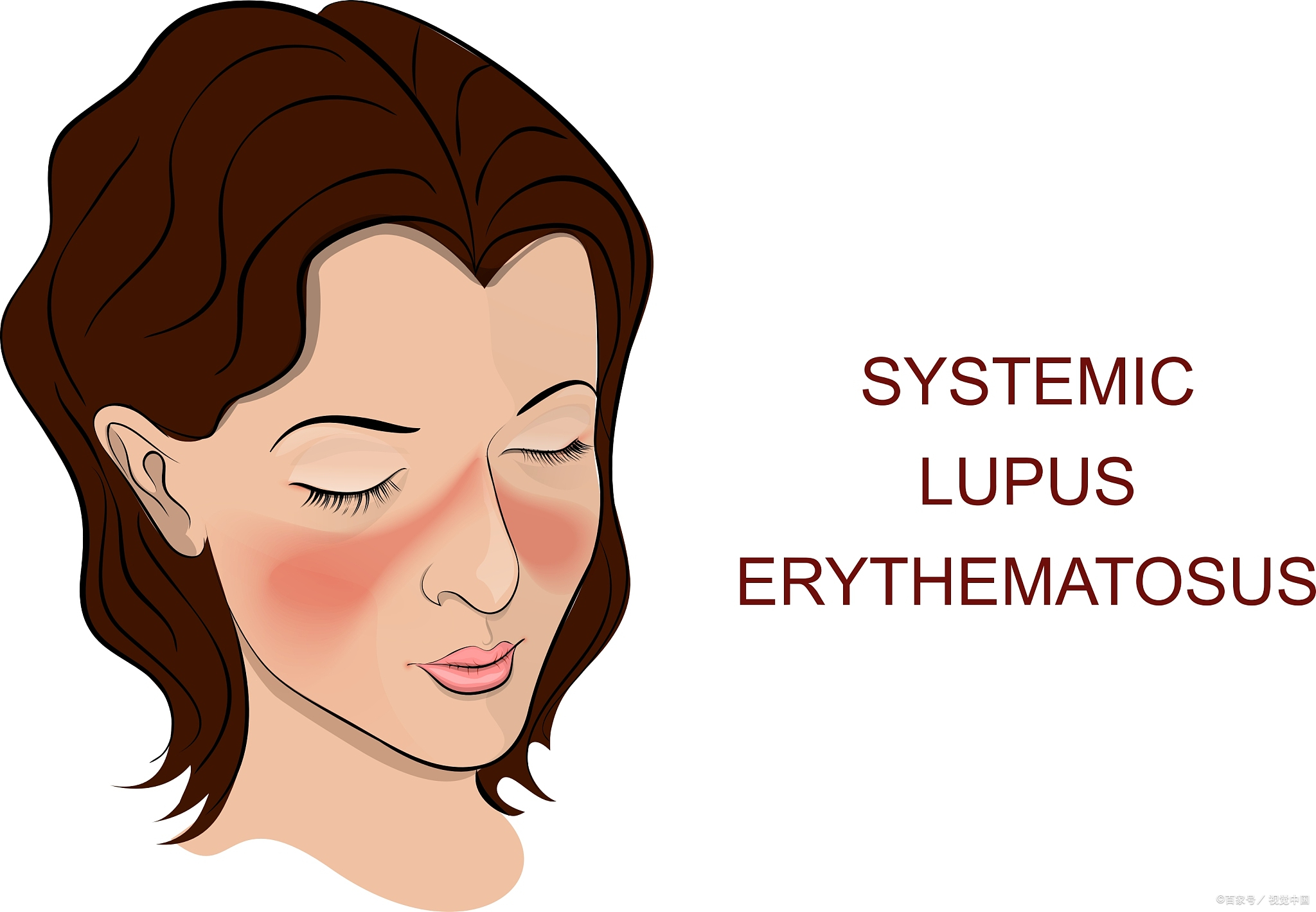 红斑狼疮与肠道管理,红斑狼疮胃肠道受累怎样治疗