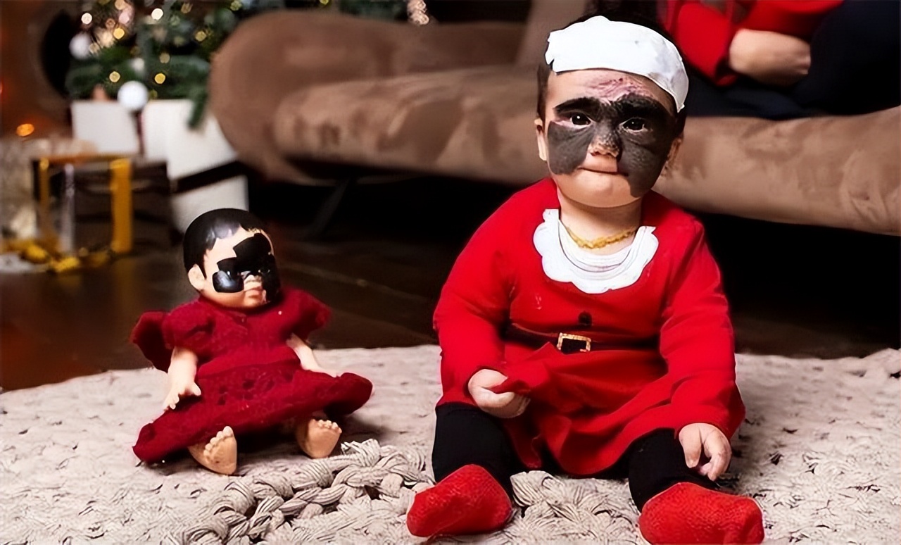 小女孩胎记后续,女童脸上长胎记去哪个医院