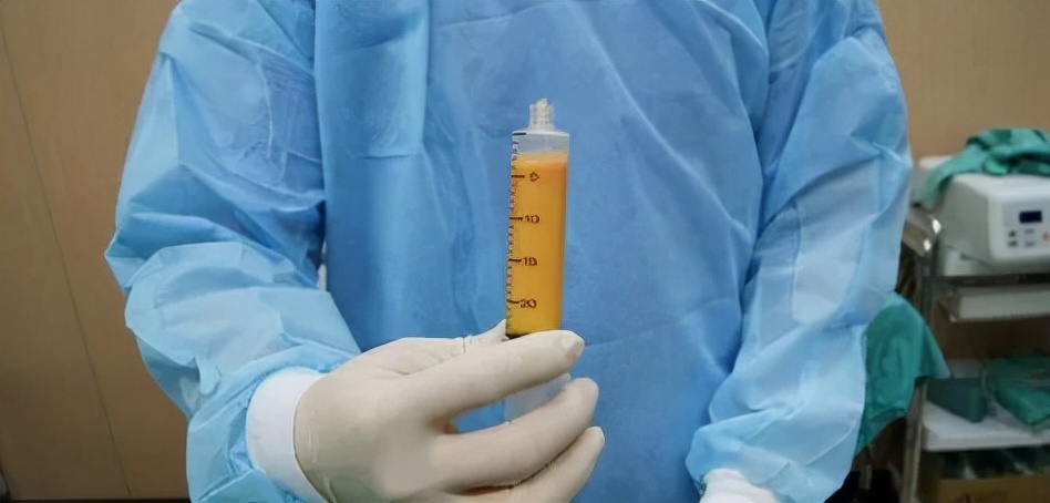 自体脂肪填充过量怎么处理,自体脂肪填充过量下巴凸怎么办