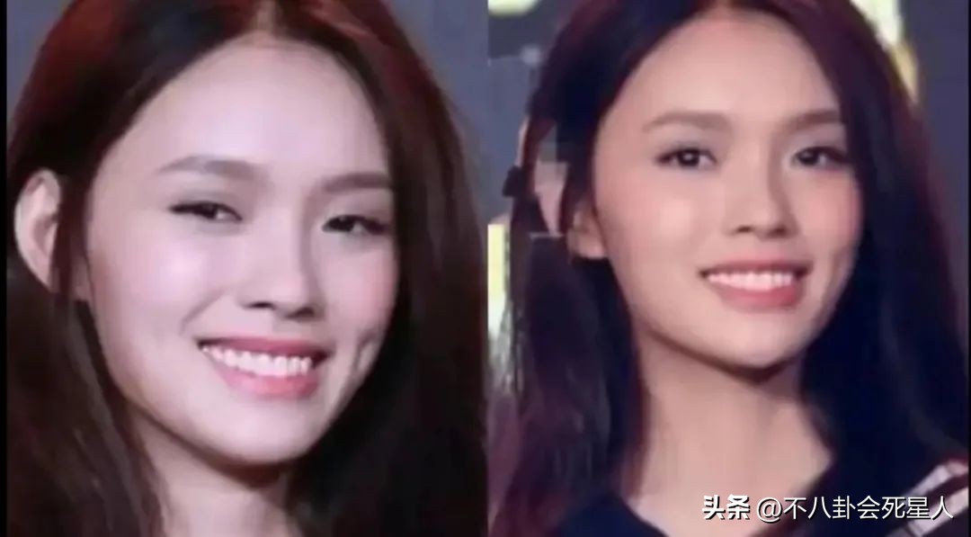 烤瓷牙有多恐怖,烤瓷牙害我一生