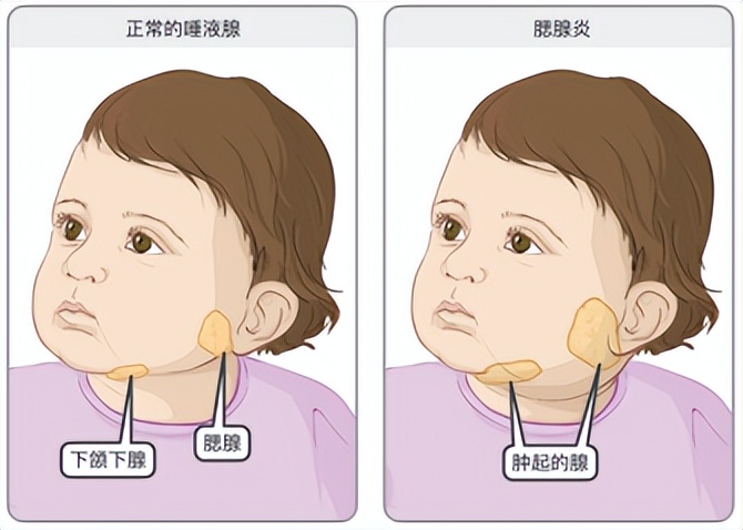 嘴巴张不开是什么综合症,嘴巴张不开是受凉引起的吗