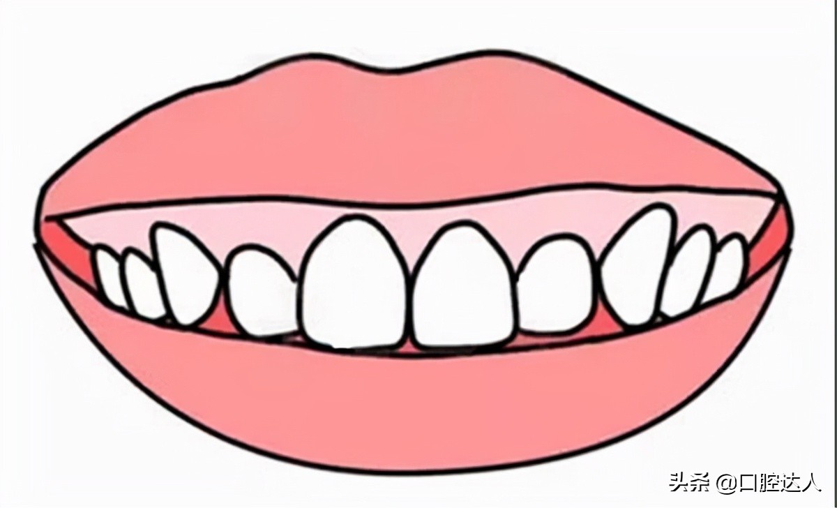 打骨钉改善露龈笑多久能看到效果,露龈笑是天生的吗